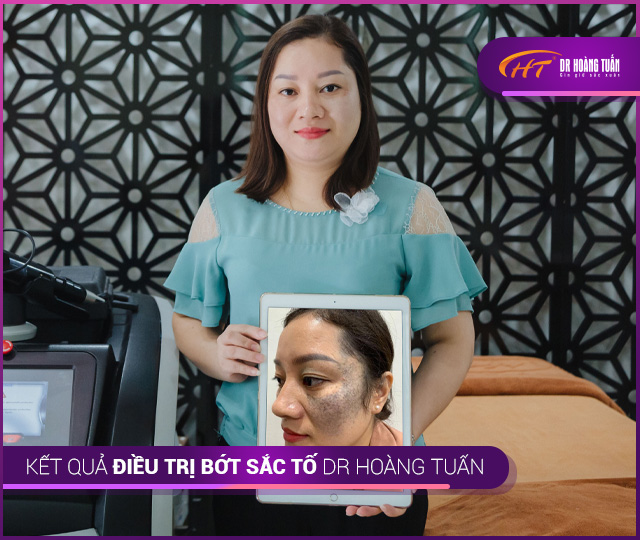 Kết quả điều trị bớt sắc tố tại Thẩm mỹ Hoàng Tuấn